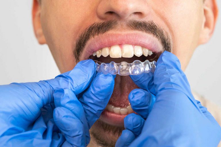 Unsichtbare Zahnspange als Alternative in der Zahnregulierung